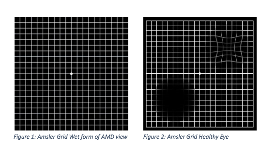 Macular Degeneration Lexington | Macular Hole Treatment Louisville, KY