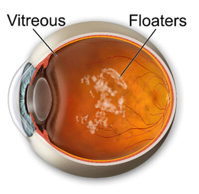 posterior vitreous detachment floaters