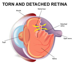 partially torn retina